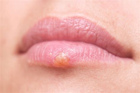 The bumps will have defined red border that surrounds the white particle. Are you worried about Tongue Herpes? Click Here!