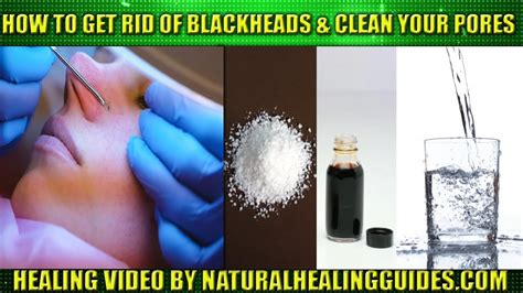 Want to know how to remove blackheads instantly? How To Remove Blackheads On Face, Nose & Cheek At Home DIY ...