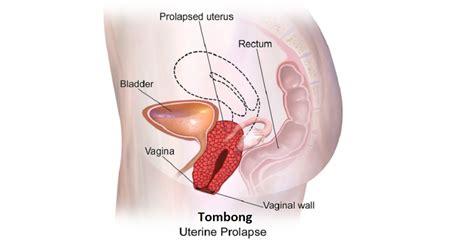 Cecair coklat boleh juga keluar dari faraj semasa menopaus, haid atau semasa hamil. Tombong: Punca, Simptom dan Rawatan - The Diagnosa