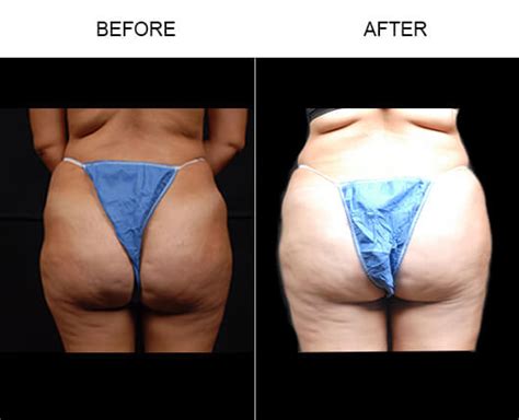 Large resection (removal) of skin and fat in the fold below the buttocks. Buttocks Enhancement Orlando, Natural Fat Transfer Florida ...