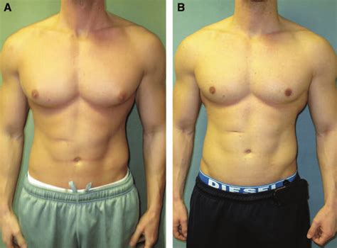 We sit down with dr. images before (a) and after (B) gynecomastia surgery in a ...