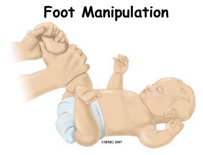 A congenitally deformed or distorted foot. Anna-Mart Kruger Physiotherapy