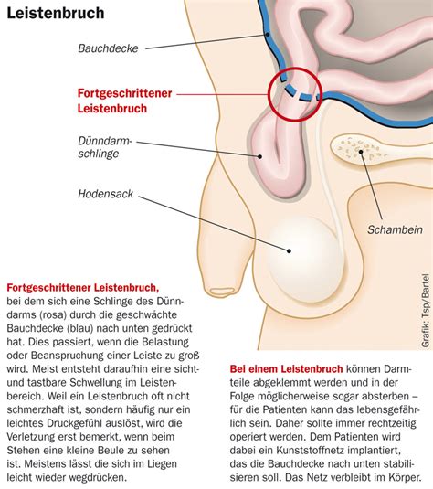 Anzeichen und symptome für einen leistenbruch. Leistenbruch | Gesundheitsberater Berlin