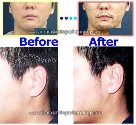 Beard minoxidil before and after. Minoxidil beard results in older men - BeardStylesHQ