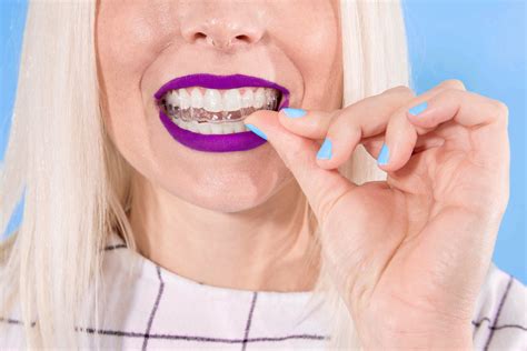 How much does braces cost in arizona. How Much Do Braces Cost? - SmileDirectClub