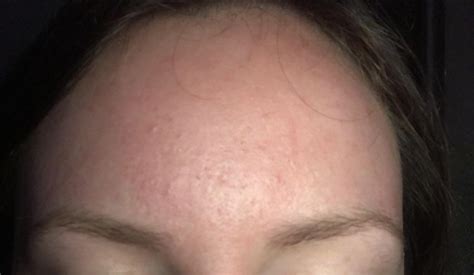 Fungal acne looks like acne but it isn't. help I can't get rid of my Fungal Acne? : Fungalacne