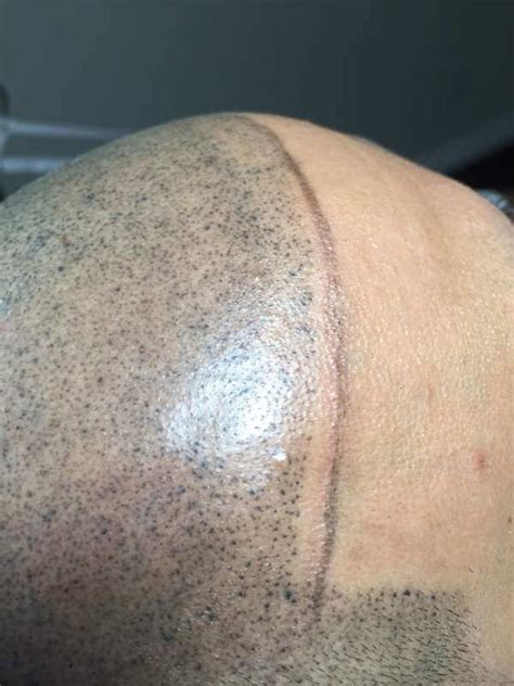 SMP Correction | FULL Micropigmentation