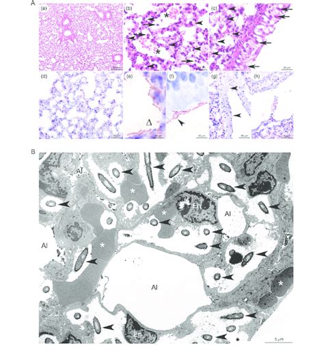 Maybe you would like to learn more about one of these? Lung parenchyma lesions and intracapillary sequestration ...