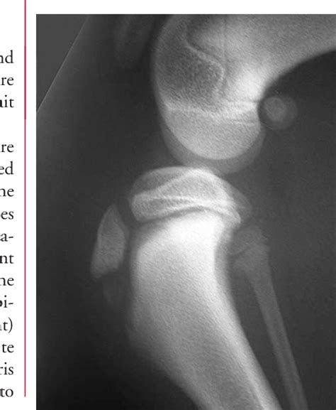 The latter mechanism leads to stress fractures. Figure 3 from Tibial tuberosity avulsion fracture in dogs ...