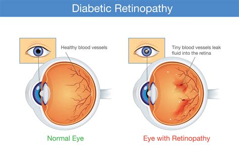 In the initial stages of diabetic retinopathy, patients are generally asymptomatic, but in more advanced stages of the disease patients may experience symptoms that include floaters, distortion, and/or blurred vision. FAQs About Diabetic Retinopathy - Elman Retina Group