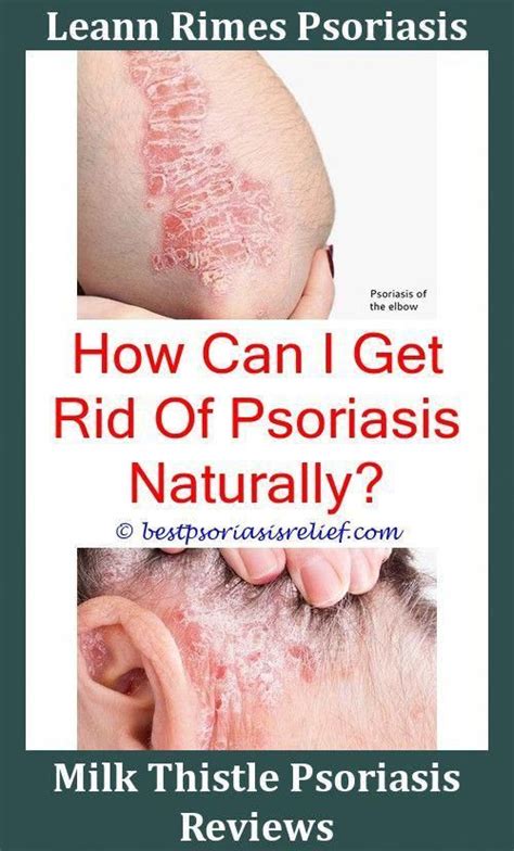 If it is covered for too many years it will die and never grow again. Nailpsoriasis Psoriasis What Does It Look Like Can ...