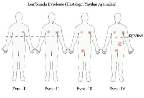 Yirmili veya otuzlu yaşlardaki kişilerde daha sık görülür. Lenfoma, Lenf Kanseri Nedir? Belirtileri ve Tedavisi nasıldır?