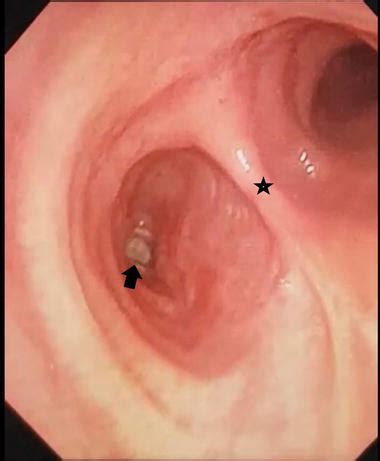 Obstetric fistula is a childbirth injury that destroys a woman's life. Bronchopleural Fistula: Causes, Diagnoses and Management ...