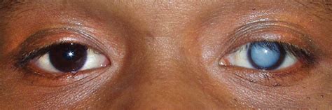 Cnn is breaking the news right now. Cataracts - Buffalo NY | Dr. Mark Sorrentino - Family ...