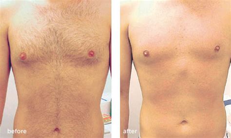 Ironically, no one in that particular forum thread seemed aware of that fact. Laser Hair Removal Treatments Before & After Photos