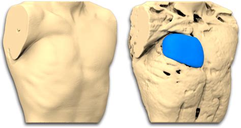 Poland's syndrome is a rare congenital disorder characterized by unilateral chest wall hypoplasia, ipsilateral hand abnormalities, and a variety of associated anomalies. Poland syndrome