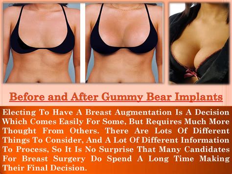 Maybe you would like to learn more about one of these? Before and after gummy bear implants by Gummy Bear ...