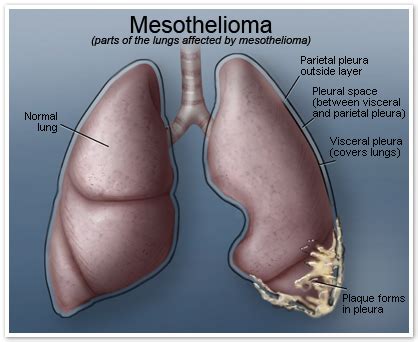 Symptoms can vary by location (lungs or abdomen) and cancer stage. Mesothelioma - malignant. Causes, symptoms, treatment ...