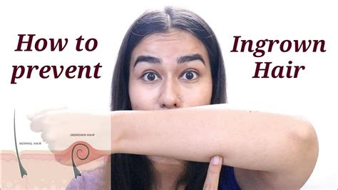 This is a skin irritation caused by ingrown hairs. How to prevent Ingrown Hair and Dark Spots on Legs & Arms ...