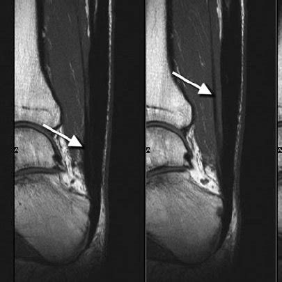 All surgery leaves scars, some more visible than others. Distal dissection of the flexor hallucis longus tendon (#) (left). ⇒... | Download Scientific ...