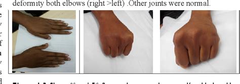 It is more properly albright hereditary osteodystrophy. PDF Rare case report of Pseudopseudohypoparathyroidism ...