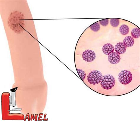 Human papillomavirus (hpv) is the most common viral infection of the reproductive tract. ویروس HPV ؛ ویروسی خطرناک در زنان و مردان/ شیوع اچ‌پی‌وی ...