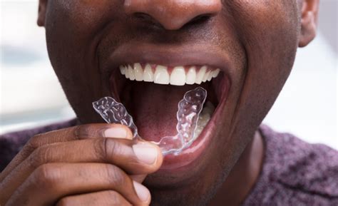 It is recommended that you get two to three opinions before moving forward with a given treatment plan, especially if it's recommended that you. How To Straighten Your Teeth Without Braces | Impressions ...