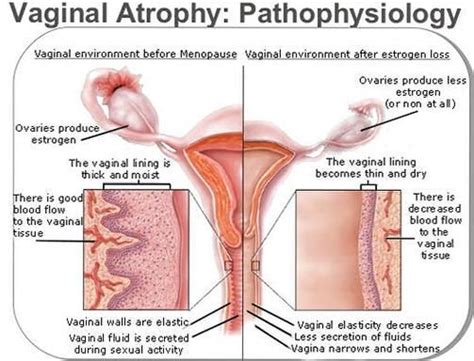 • common symptoms include pelvic. Pin on body