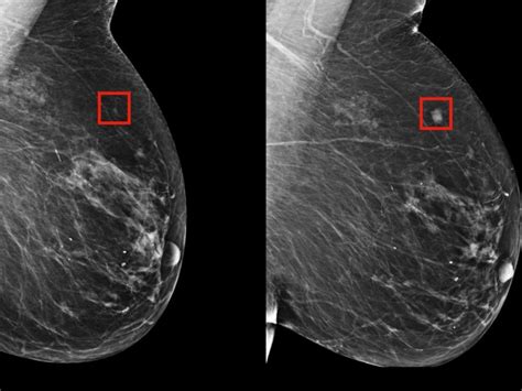 Le cancer du sein est le cancer le plus diagnostiqué chez les femmes à travers le monde, autant avant qu'après la ménopause1. Dépistage : l'IA du MIT qui prédit l'apparition du cancer ...