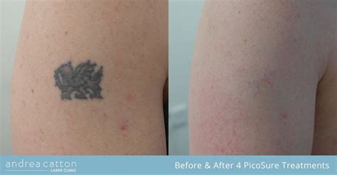 Picosure laser eyebrow tattoo removal is something i perform regularly. PicoSure® Tattoo Removal UK | Tattoo removal cost ...