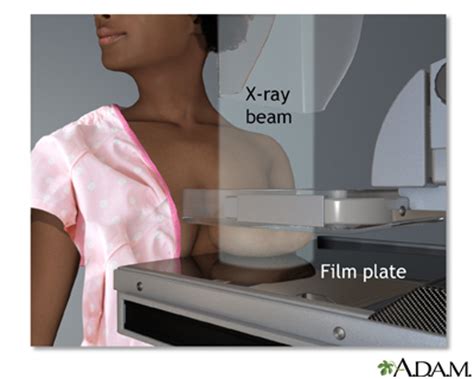 Breast cancer is much more treatable when detected in its early stages. Mammogram - calcifications | Healthing.ca