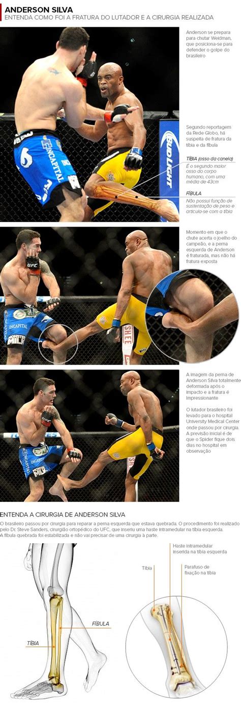 This is chris weidman gets his leg snapped. by youtube algorithm on vimeo, the home for high quality videos and the people who love them. Anderson Silva posta foto durante tratamento e avisa: 'Vou ...