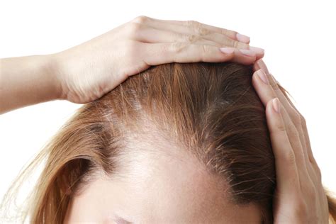 Authoritative facts from dermnet new zealand. What Is Alopecia Areata? | Kessel Dermatology