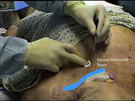 Mesothelioma biopsies are the examination of tissue removed from a living body to discover the presence, cause, or extent of a disease. Pleural Mesothelioma Biopsy