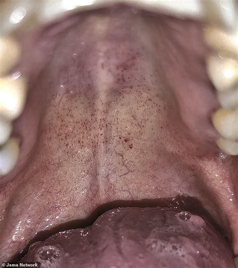 Her legs have also been feeling numb. Red rash-like splotches in the MOUTH may be a new symptom ...