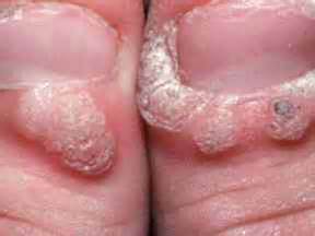 These are capillaries that supply it with blood. LA LAser center offers effective wart treatment in south ...