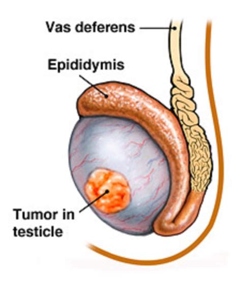 Neutering does not protect against future development of prostate cancer in dogs. Testicular Cancer, Symptoms, Types, Causes and Treatment ...