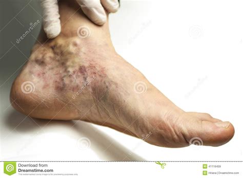A trombose é a formação de um coágulo sanguíneo em uma veia, geralmente das pernas. Veine variqueuse image stock. Image du lifestyle, santé ...