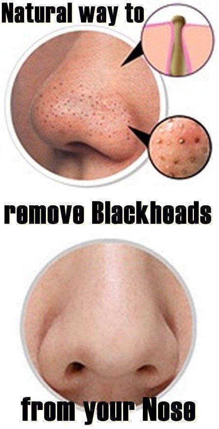 When it comes to learning how to get rid of blackheads, weird as it may sound, green tea is a really amazing treatment for blackhead removal. Pin on Blackheads