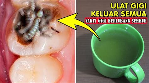 Manakala anda mengalami sakit gigi, ada sejumlah jenis obat sakit gigi yang bisa dikonsumsi untuk meredakan sakit gigi yang diderita. TAK PERLU OBAT DOKTER! SAKIT GIGI BERLUBANG SEMBUH TOTAL ...