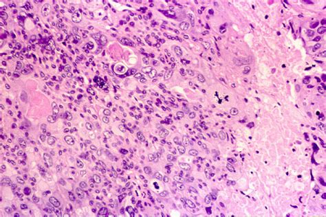 O adenoma pleomórfico é o tumor benigno de origem glandular mais freqüente na cavidade oral. MORFOMETRIA DE LA HIPERPLASIA Y EL CARCINOMA DUCTAL DE MAMA