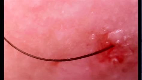 This article, will attempt to cover in details the symptoms of ingrown. Removal of an ingrown hair from my neck - YouTube