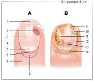 Das hauptsymptom einer sehnentzündung oder tendinitis sind schmerzenden sehnen in der nähe eines gelenkes. Abbildung Schmerzen im großen Zeh