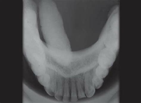 A hard deposit occurring in a salivary gland | meaning, pronunciation, translations and examples. Topographical mandibular occlusal radiograph revealing ...