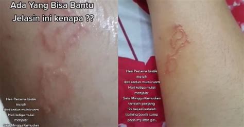 Percaya tak jika saya katakan, dalam badan kita semua ni ada cacing (parasit) untuk entry yang ni saya akan share apakah tanda2 kepada seseorang yang mengidap kecacingan. (Video) Ketahui 'Creeping Eruption' Yang Disebabkan Oleh ...