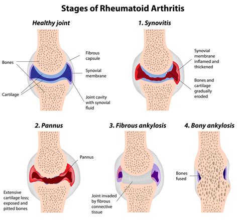 Browse recommended jobs for you. Stages-of-rheumatoid-arthritis-copy - The Orthopedic ...
