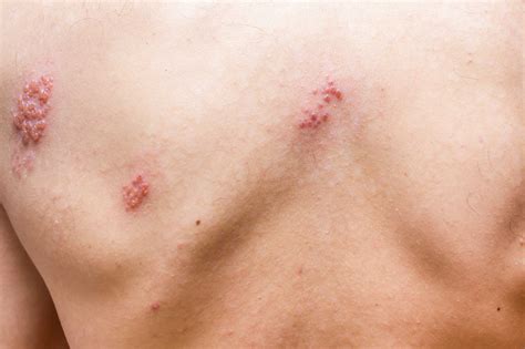 Sjukdomen karaktäriseras av en unilateral blåsbildning i huden som utbreder sig över ett dermatom, oftast thorakalt, men kan uppstå på alla delar av kroppen. Kan man få bältros av någon som har vattkoppor ...