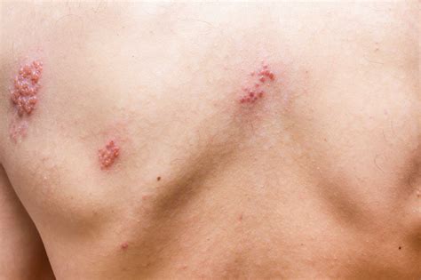 Visste du att det finns bältrosvaccin? Kan man få bältros av någon som har vattkoppor ...