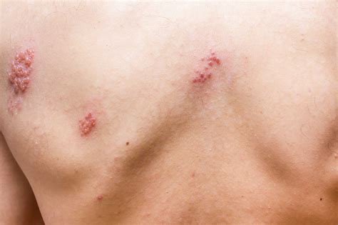 Bältros också känd som herpes zoster, är en viral hudsjukdom som härstammar från vattkoppsviruset varicella zoster. Kan man få bältros av någon som har vattkoppor ...