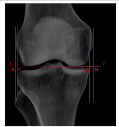 Knee measurements. E-F, horizontal distance between ...